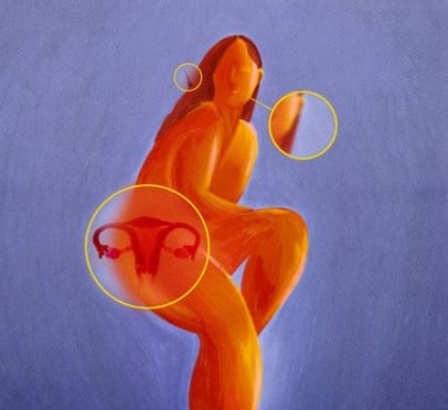 PCOS: sintomas, tratamento e por que muda para PMOS
