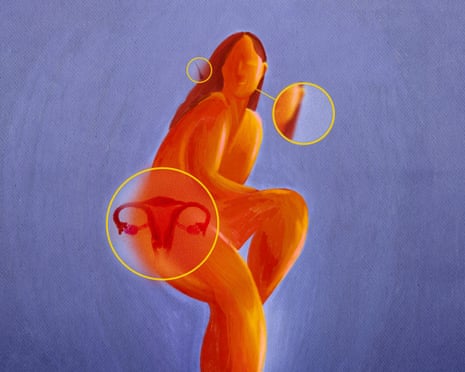 PCOS: sintomas, tratamento e por que muda para PMOS