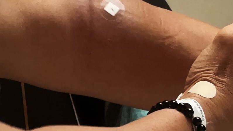 Imagem mostra inchaço em braço do senador Magno Malta após alegada falha em exame realizado em hospital de Brasília