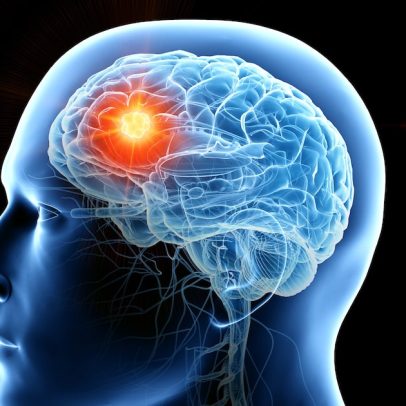 Tumores cerebrais: sinais, diagnóstico e opções de tratamento
