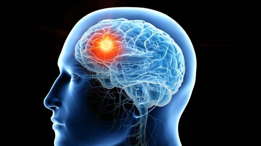 Dores de cabeça persistentes e progressivas estão entre os principais sintomas de tumores cerebrais