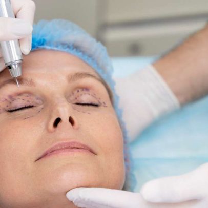 Blefaroplastia remodela pálpebras e rejuvenesce o olhar
