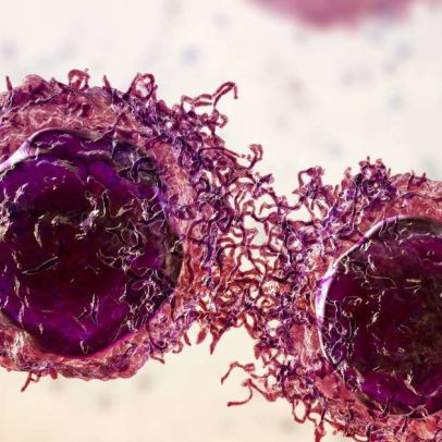 Pembrolizumabe pode manter câncer colorretal livre da doença por anos
