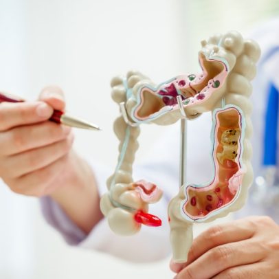 Câncer de intestino: como identificar estágio inicial, com Chico Pinheiro