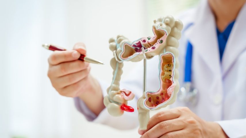 Colonoscopia é a melhor forma de detectar precocemente o tumor ou os pólipos intestinais antes de eles virarem um câncer