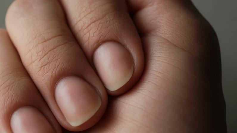 Unhas quebradiças – depositphotos.com / LyaNevada