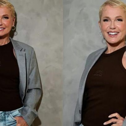 Xuxa revela transplante capilar: entenda o procedimento