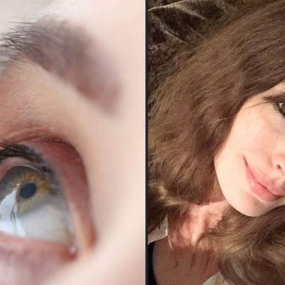 Anne Hathaway revela problema de visão silencioso e alerta especialistas