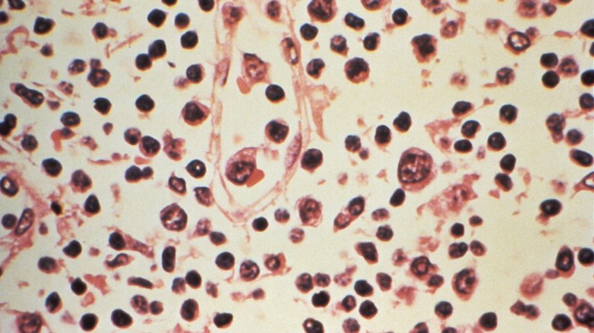 Some of the cytoarchitectural features in a lymph node specimen extracted from a patient suspected of a Hantavirus illness is seen in this handout photo.