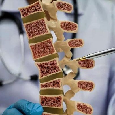 Sinais precoces da osteoporose surgem antes da primeira fratura, alerta médica