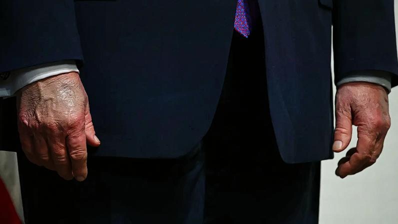 Circulação: Trump tem hematomas nas mãos e falta de filtro nas falas // (KENT NISHIMURA/AFP)