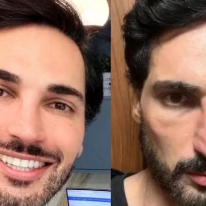 Influenciador relata dano facial após uso de caneta emagrecedora