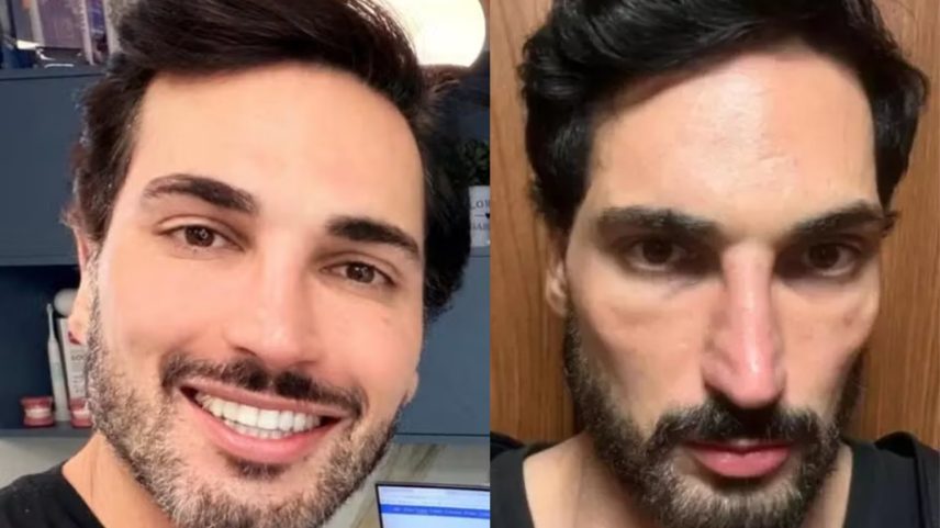 Lucas Estevam falou sobre os efeitos de caneta emagrecedora após 60 dias de uso