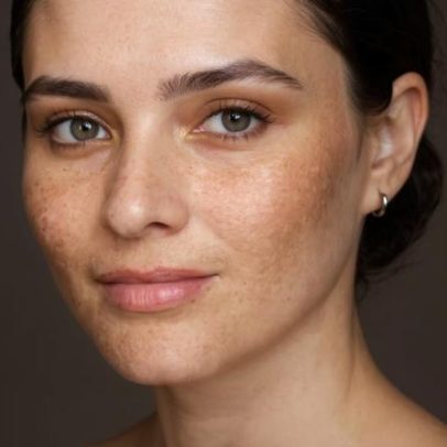 Melasma: por que aparecem as manchas e como tratá-las