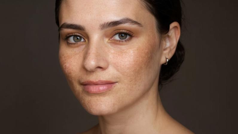 Opinião | Melasma: por que essas manchas aparecem? Tem solução? Tire dúvidas