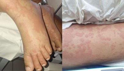 Exame descarta contaminação por detergente em criança internada no RN