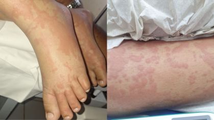 Criança estava internada com diversas manchas pelo corpo
