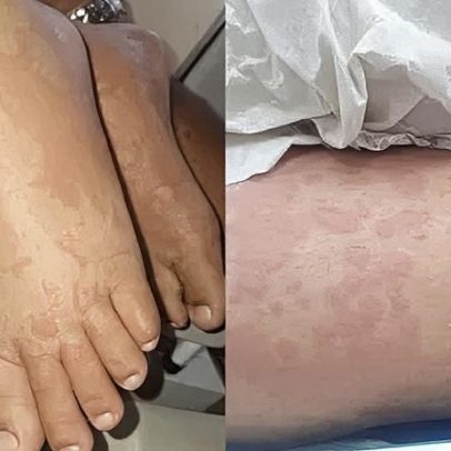 Criança internada no RN teve manchas após uso de detergente, diz tio