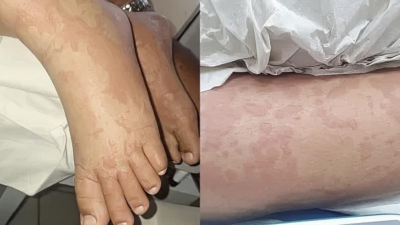Criança está internada com diversas manchas pelo corpo