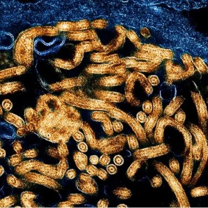 Entenda por que o Ebola é um dos vírus mais letais do mundo