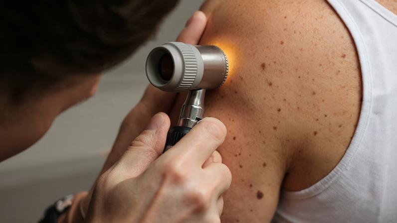 Desenvolvida para pacientes com melanoma avançado, a vacina utiliza o DNA do paciente para criar uma resposta imunológica personalizada