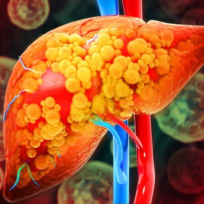 Alimentos a evitar para prevenir gordura no fígado, segundo especialistas