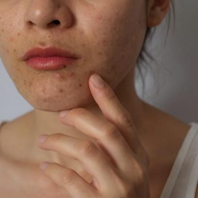 Nova diretriz europeia atualiza tratamento da acne após quase 10 anos