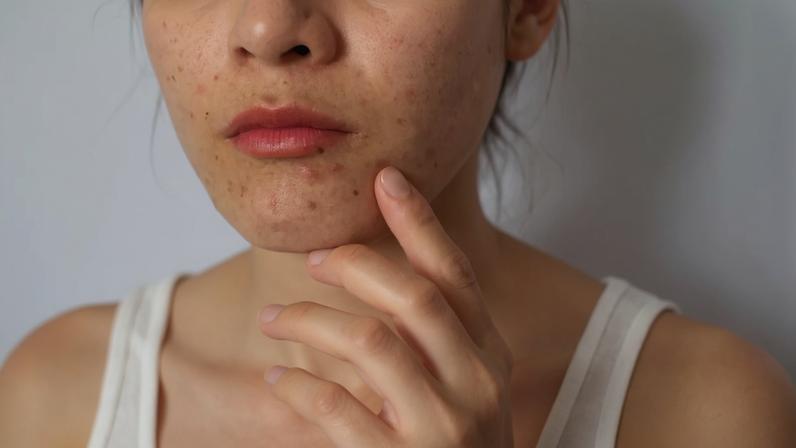 Diretriz europeia: isotretinoína segue sendo indicada como principal tratamento para acne grave