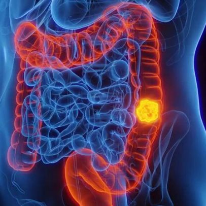 Novo teste do SUS para detecção precoce de câncer colorretal antes de sintomas