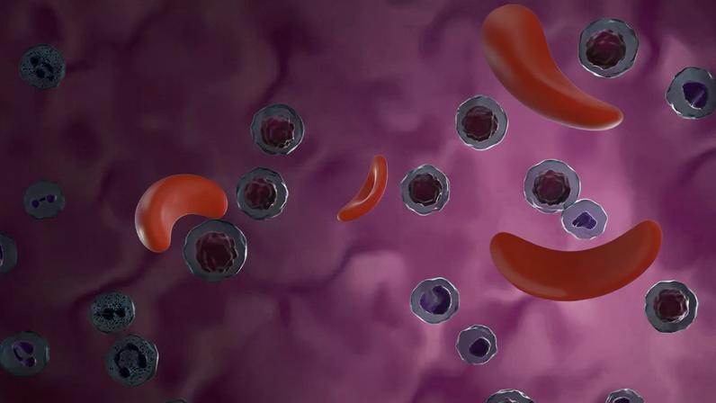 Doença falciforme: até 100 000 brasileiros enfrentam o distúrbio marcado por uma alteração nas células do sangue (Foto: Nemes Laszlo/Getty Images)