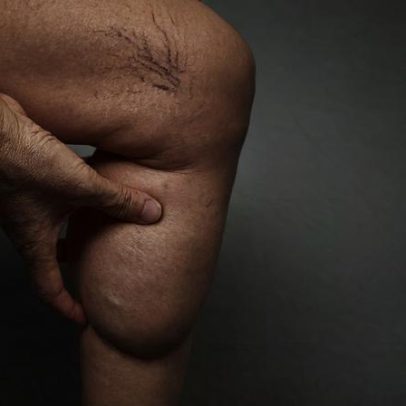Pernas e pés inchados: o que isso pode indicar, segundo médica
