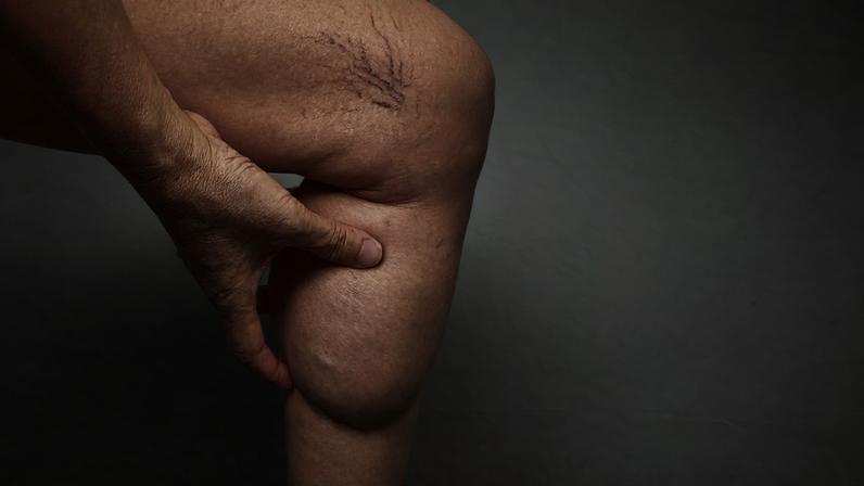 1 de 1 lipedema - Foto: Rungrudee/Getty Images
