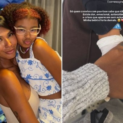 Cantora Pocah leva filha ao hospital após crise de psoríase