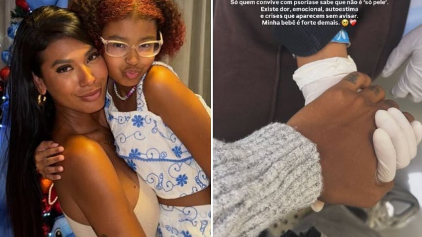 Cantora Pocah leva filha ao hospital após crise de psoríase