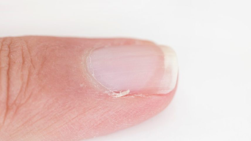 Cutícula solta não deve ser arrancada com os dentes, prática que pode favorecer infecções.