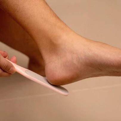 Qual a melhor forma de remover calos dos pés, segundo especialistas