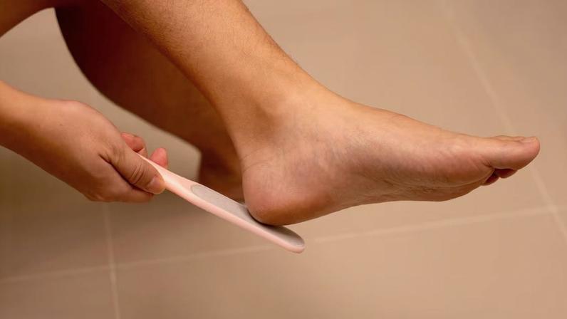 Se a pele ficar muito espessa, os calos podem ficar sensíveis e causar desconforto