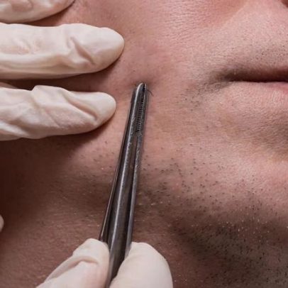 Transplante de barba: como funciona e quem pode realizar