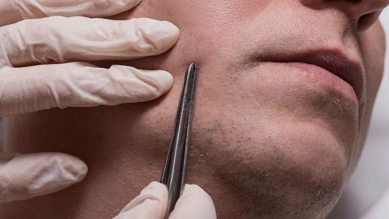 O transplante de barba pode ajudar a camuflar cicatrizes e aumentar a densidade dos pelos faciais