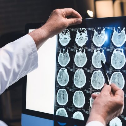 Primeiro medicamento contra o Alzheimer chega ao Brasil em junho