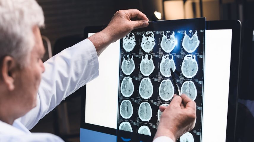 Primeiro remédio contra o Alzheimer chega ao Brasil em junho e marca nova era no combate à doença