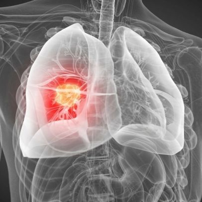 Oncologia avança com novas estratégias de detecção do câncer de pulmão