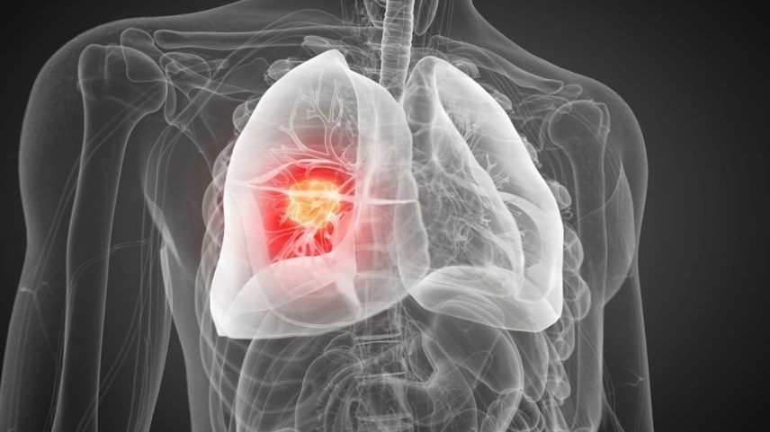 Oncologia avança com novas estratégias de detecção do câncer de pulmão
