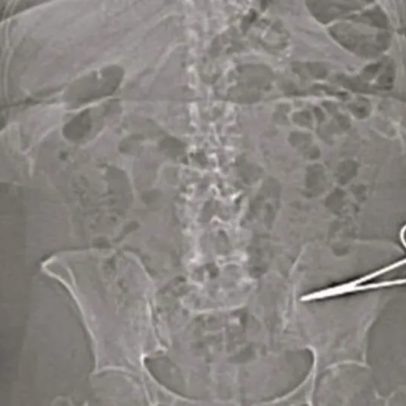 Mulher encontra tesoura alojada no abdômen 7 meses após cirurgia na Itália