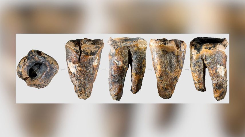 A evidência mais antiga de cirurgia dentária era de um dente de Homo sapiens de 14.000 anos atrás