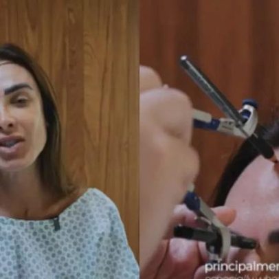 Nicole Bahls faz transplante capilar devido à alopecia