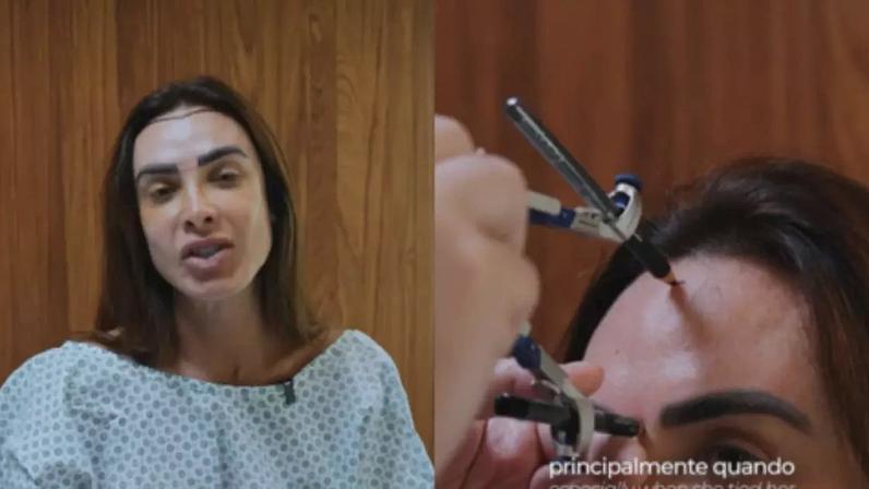 Nicole Bahls realiza transplante capilar