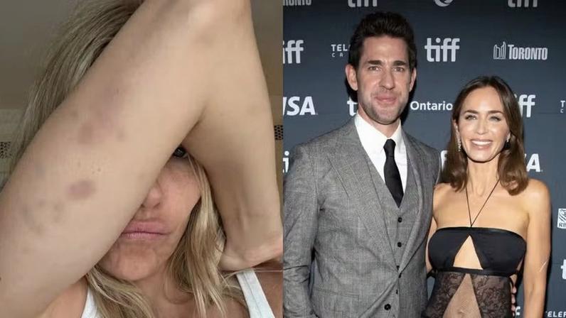 Hematomas de Sienna Miller; os atores John Krasinski e Emily Blunt