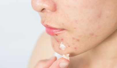 Acnes na adolescência: por que aparecem e como lidar