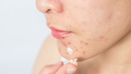 Mudanças hormonais contribuem para o aparecimento de acnes